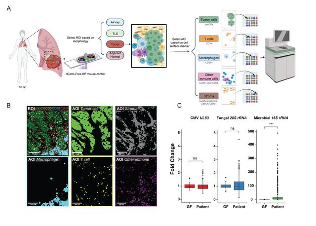 Spatial meta-transcriptomics reveal associations of intratumor bacteria burden with lung cancer cells showing a distinct oncogenic signature